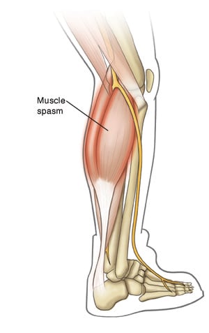 Outline of right lower leg, showing spasm in calf muscle.