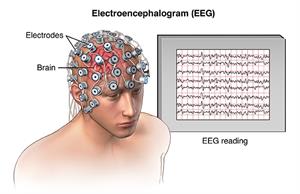Electrodes placed all over person's head for an EEG, showing readings of brain activity.