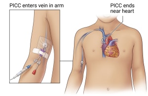 PICC placed in arm just above the elbow connects to veins near the heart.