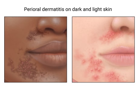 Perioral dermatitis on a dark-skinned face and on a light-skinned face.