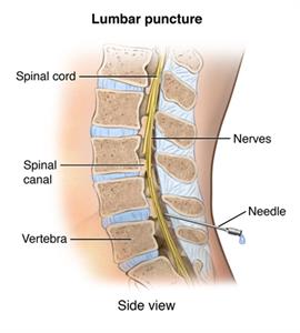  Side cut view of the lumbar spinal cord with a needle inserted into the spinal canal.