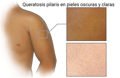 Queratosis pilaris en la parte superior del brazo, con detalle de cómo se ven las pequeñas protuberancias en pieles oscuras y claras.