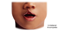 Click Image to Enlarge Illustration of a unilateral incomplete cleft lip