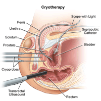 Click image to enlarge Cryotherapy procedure