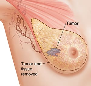 Three-quarter view of female underarm area showing breast anatomy ghosted in. Dotted line shows tissue and lymph nodes removed in modified radical mastectomy.