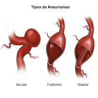 Ilustración de los tipos de aneurismas cerebrales