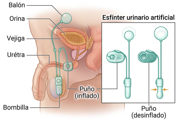 Anatomía interior del aparato reproductor masculino que muestra un esfínter urinario artificial unido por un manguito en la uretra, una bomba que cae por el escroto y un globo que se encuentra por encima de la vejiga. La llamada muestra que el manguito puede inflarse para apretar la uretra y hacer que el balón sea más pequeño. El manguito puede desinflarse para crear presión en la bomba y hacer que el balón sea más grande.